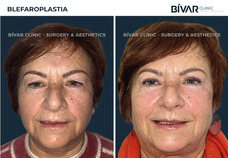 blefaroplastia1