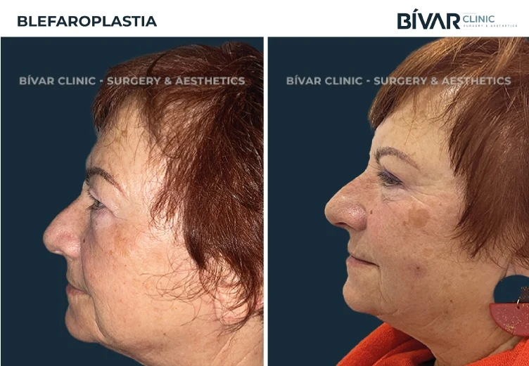 blefaroplastia2