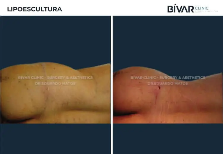 lipoescultura2
