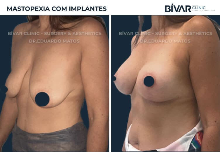 mastopexia-com-implantes2