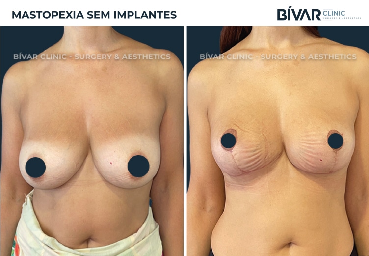 mastopexia-sem-implantes1