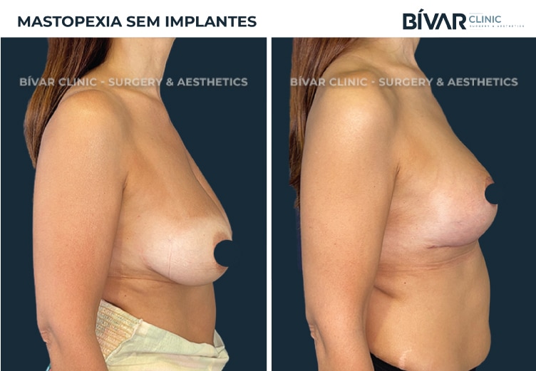 mastopexia-sem-implantes2