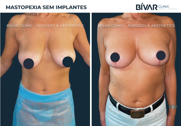 mastopexia-sem-implantes3