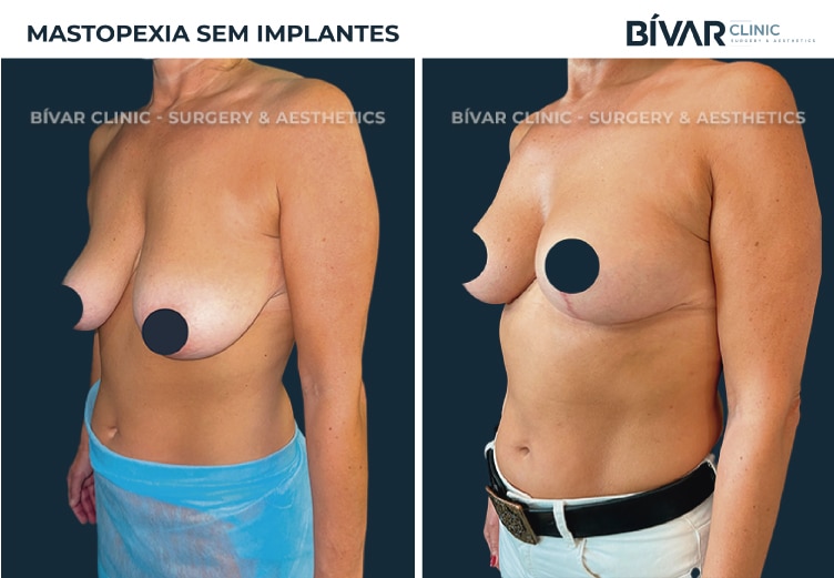 mastopexia-sem-implantes4