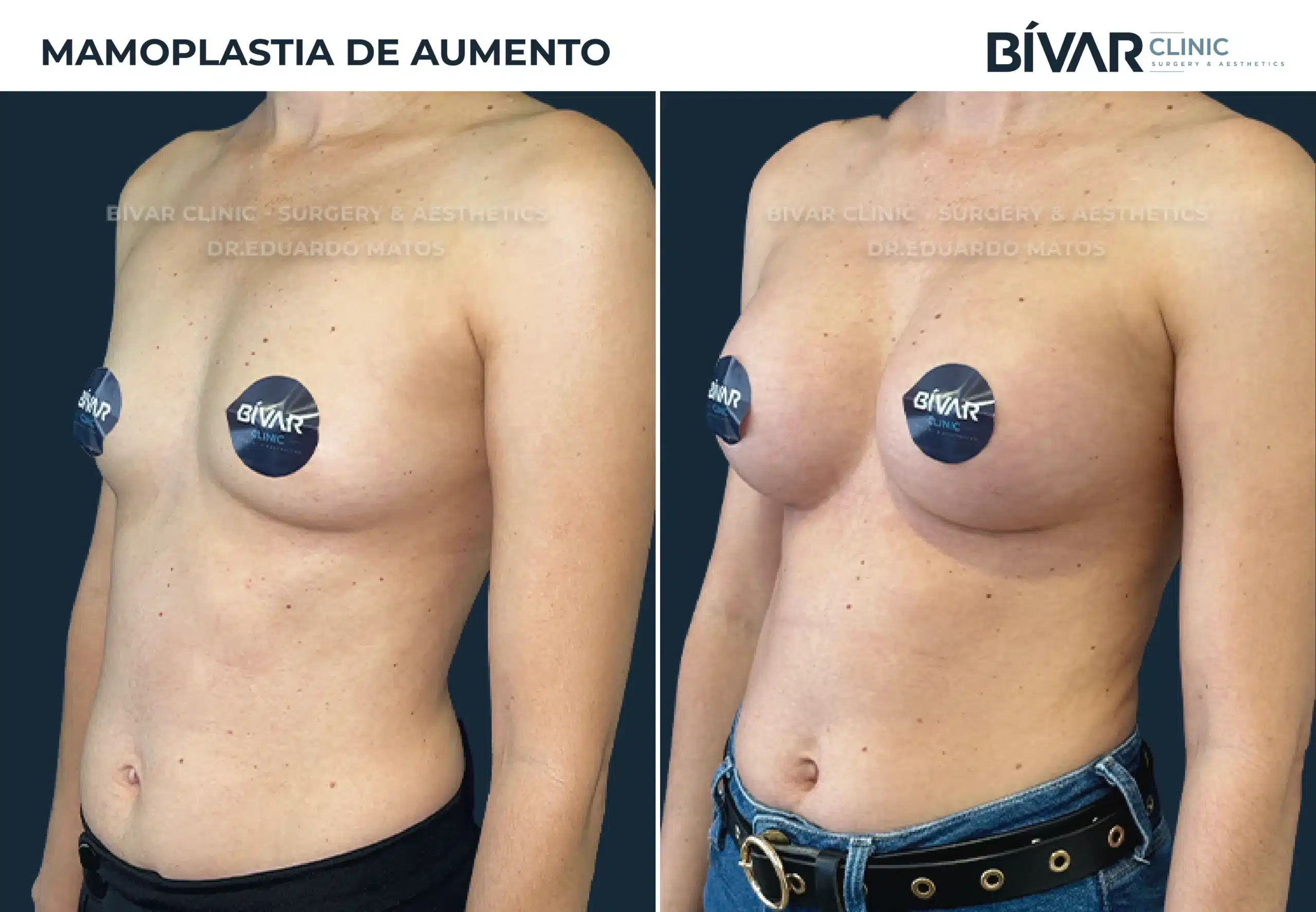 mamoplastia-aumento-v1.2