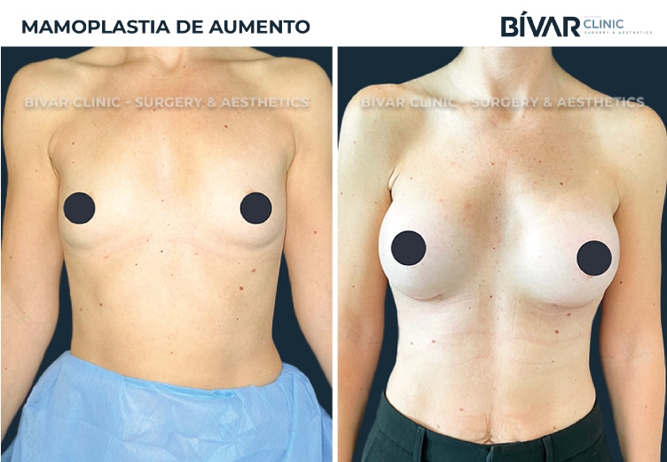 mamoplastia-aumento-v2.1