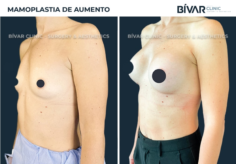 mamoplastia-aumento-v2.2