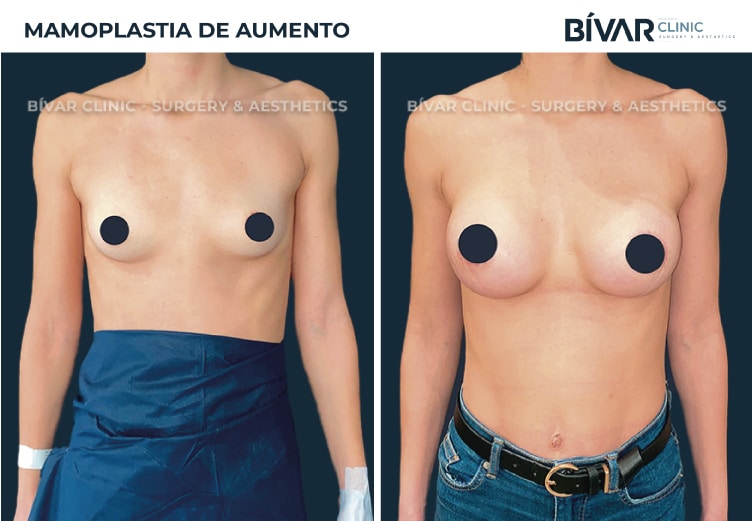 mamoplastia-aumento-v3.1