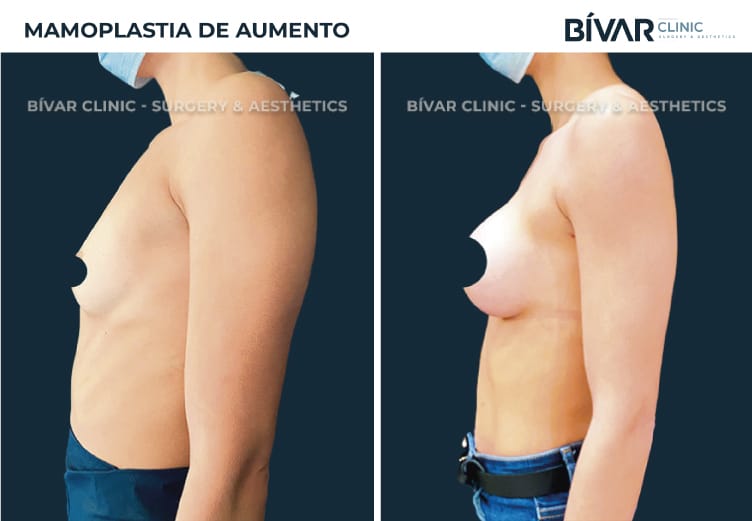 mamoplastia-aumento-v3.2