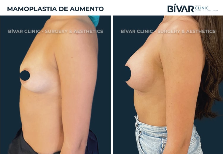 mamoplastia-aumento-v4.2