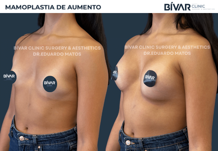 mamoplastia-aumento-v5.2