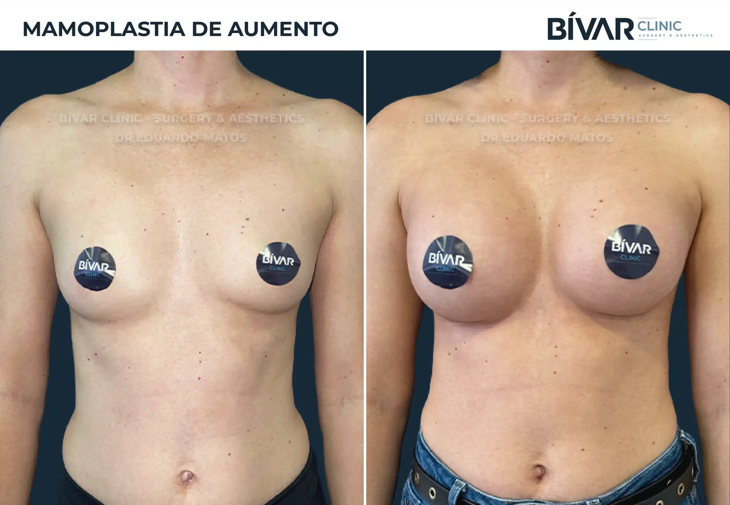mamoplastia-aumento-v6.1