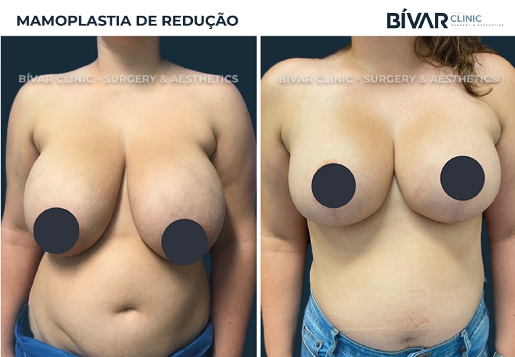 mamoplastia-reducao1