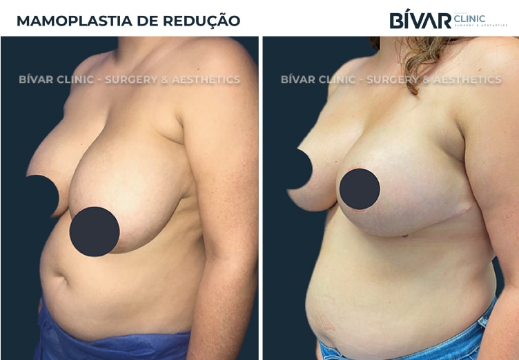mamoplastia-reducao2